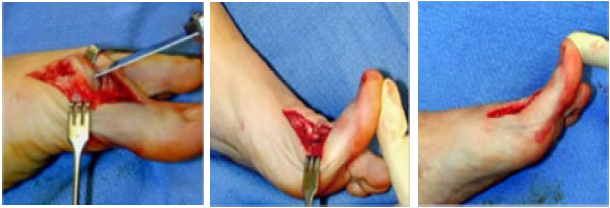 Dorsal Bunion Natural Treatment Dorsal Bunion Natural Treatment