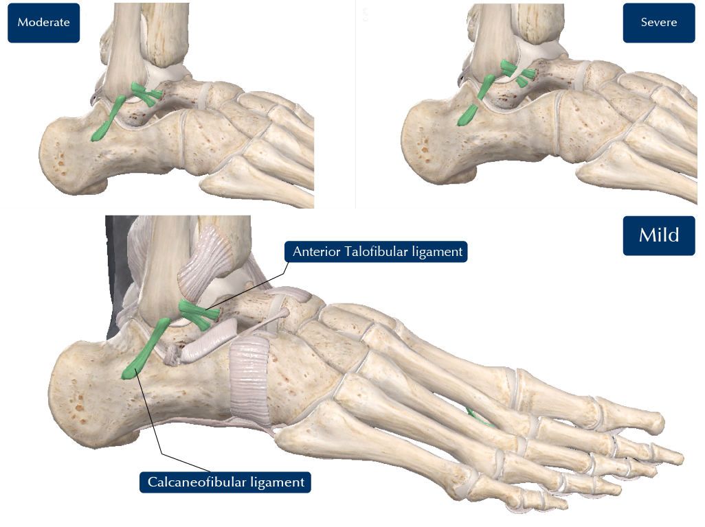 Mild Moderate and Severe Ankle sprain