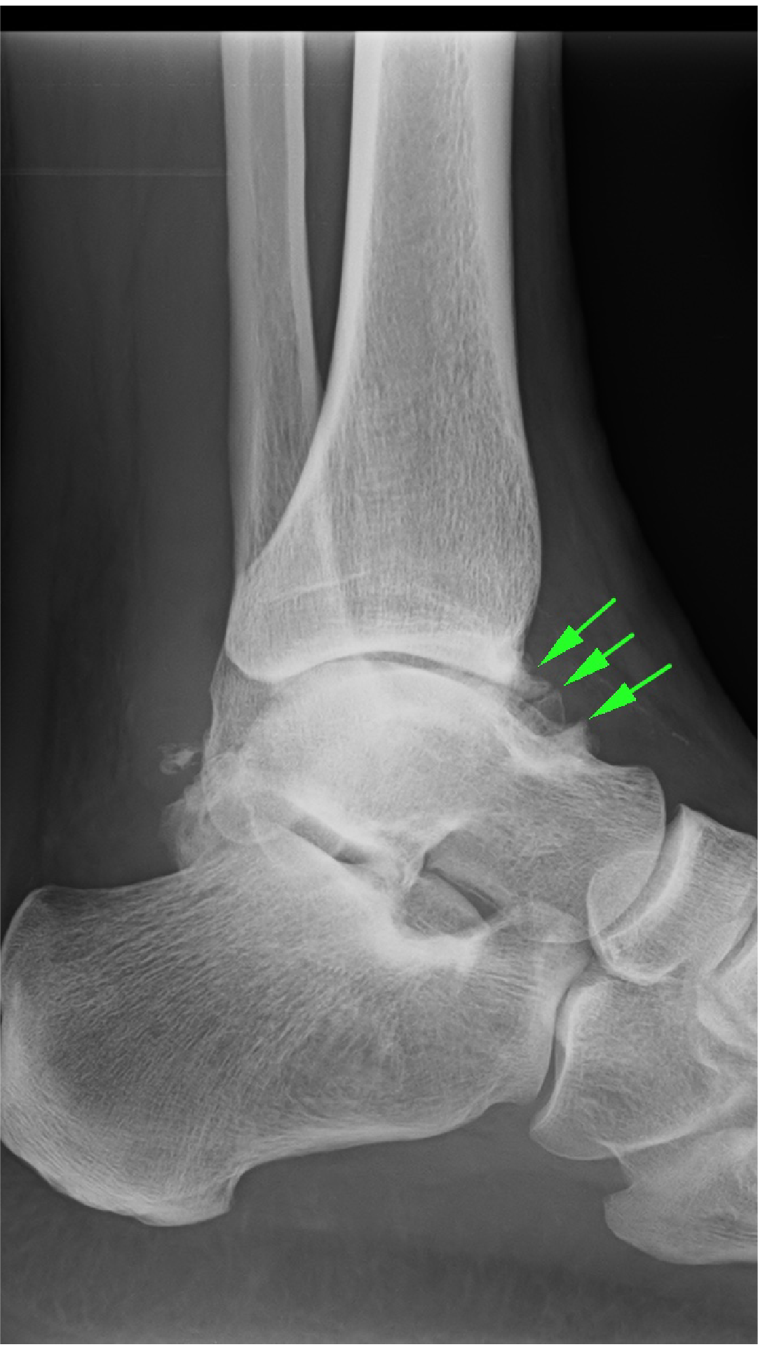 Bone spurt at the ankle joint