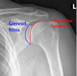 X-ray of a normal shoulder